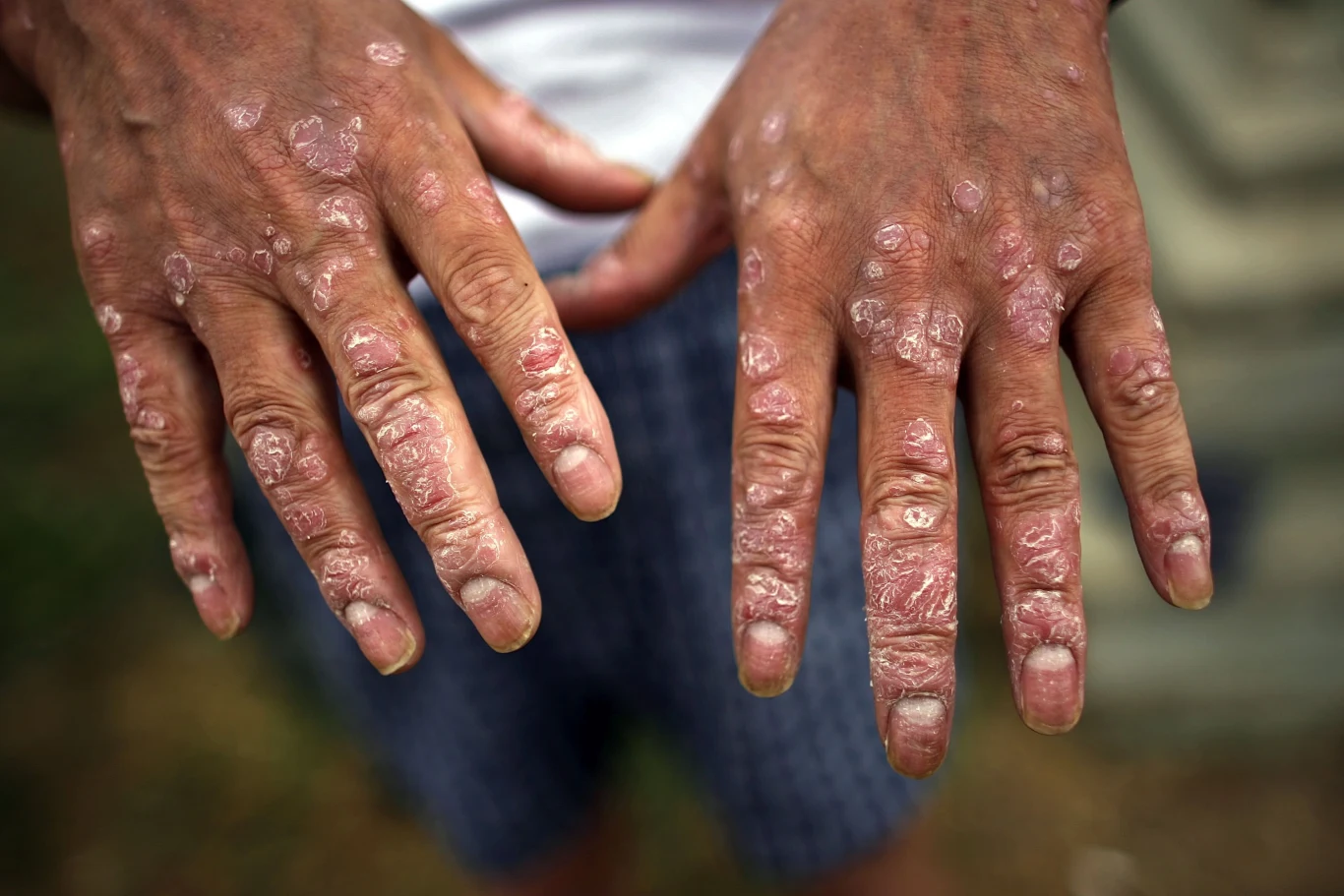 Defolianty zrzucone przez wojska USA podczas wojny w Wietnamie zawierały trujące dioksyny powodujące zmiany skórne, zwiększające ryzyko zachorowań na raka oraz upośledzenia płodów. Skutki użycia chemikaliów odczuli zarówno Wietnamczycy, jak i amerykańscy weterani