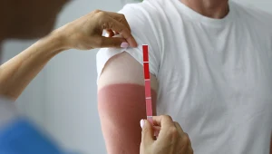 Słońca nie można bagatelizować. Oparzenia słoneczne mogą prowadzić do raka skóry