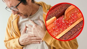 Rozwarstwienie aorty jest stanem nagłym. Objawy mogą przypominać zawał serca