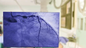 W koronografii do tętnicy wprowadza się cewnik, przez który lekarz podaje kontrast, a następnie wykonuje się zdjęcia rentgenowskie