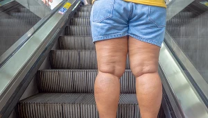Walka z lipodemią jest ciężka. Chorym doradza się ćwiczenia fizyczne, masaże, dietę i odpowiednie nawadnianie