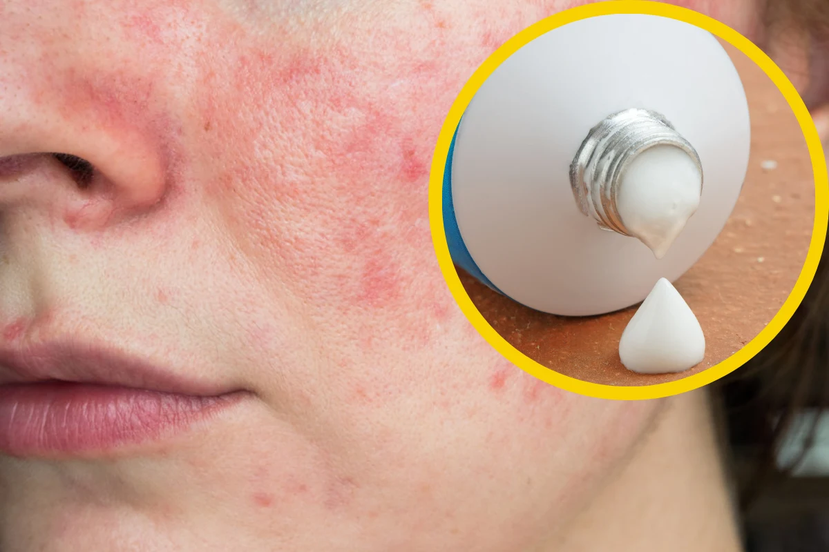 Maści poradzą sobie z trądzikiem, niedoskonałościami i pomogą zregenerować skórę