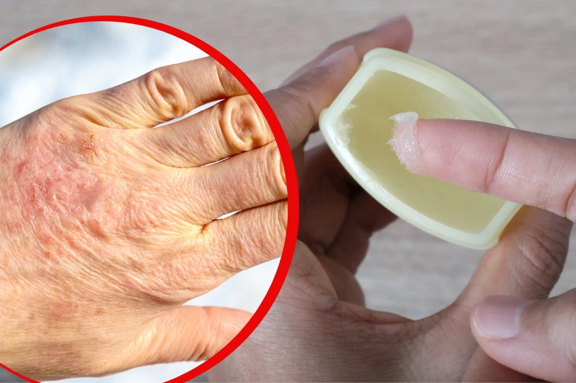 Maść z jaskółczym zielem stosowana jest również w egzemie, atopowym zapaleniu skóry czy w przesuszeniach