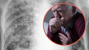 Sarkoidoza w układzie oddechowym wywołuje zmiany w płucach. Ich efektem jest kaszel, uczucie duszności i bóle w klatce piersiowej /Picsel