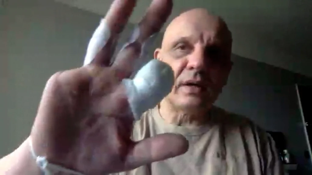 Oleg Moskalenko w wywiadzie dla CNN pokazuje pozbawioną dwóch palców rękę Oleg Moskalenko w wywiadzie dla CNN pokazuje pozbawioną dwóch palców rękę