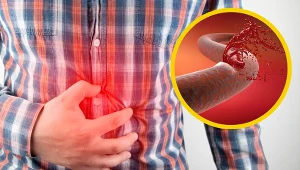 Ryzyko pęknięcia tętniaka zależy przede wszystkim od jego lokalizacji i średnicy