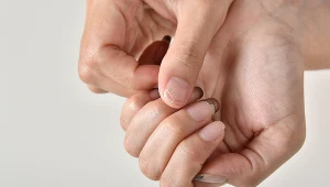 Czerniak paznokcia jest jednym z najtrudniejszych diagnostycznie nowotworów. Jakie objawy na niego wskazują? 