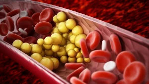 Na podwyższony poziom trójglicerydów wpływ ma także niedobór snu, stres czy niedoczynność tarczycy