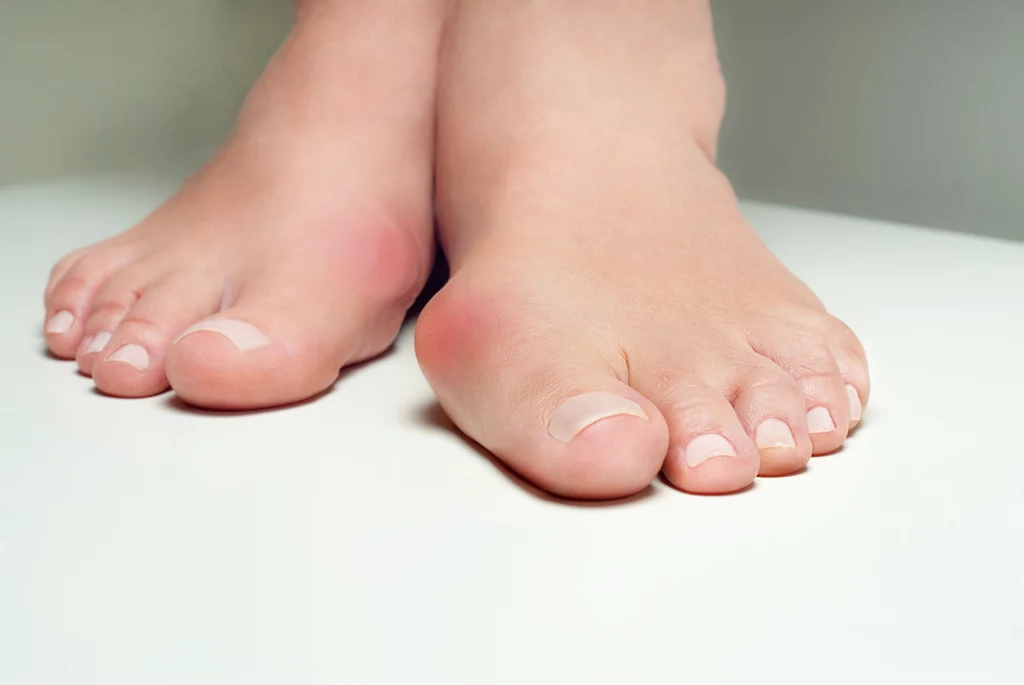 Haluksy to schorzenie, które polega na deformacji stopy i odchyleniu palucha na zewnątrz