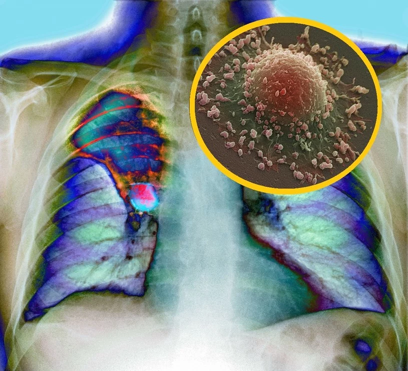 Nowotwór płuc wzięty na celownik przez polskich naukowców. Szczepionka może być kluczem do rozprawienia się z tą chorobą.