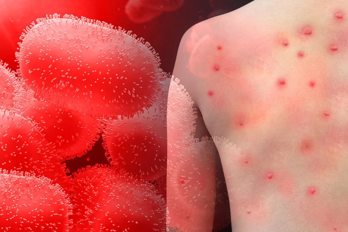 Na całym świecie liczba osób chorujących na małpią ospę przekroczyła 26 tysięcy w ponad 80 krajach