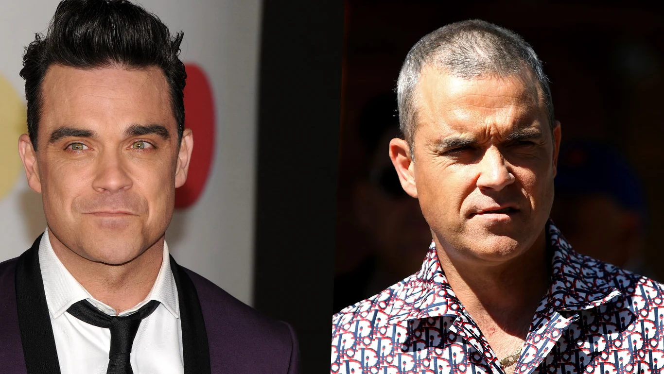 Robbie Williams traci włosy. Nie pomagają mu nawet drogie terapie Robbie Williams traci włosy. Nie pomagają mu nawet drogie terapie