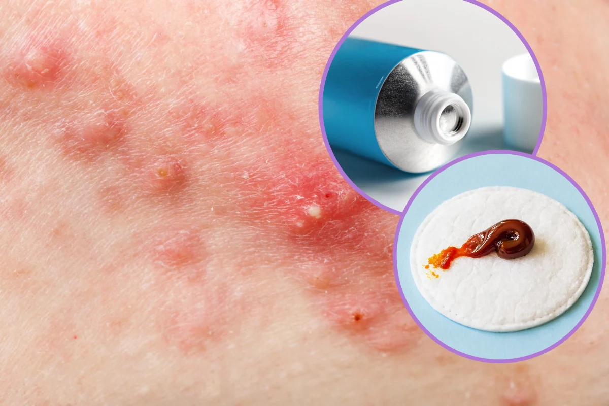 Maść ichtiolowa jest tanim i skutecznym sposobem na walkę z trądzikiem Maść ichtiolowa jest tanim i skutecznym sposobem na walkę z trądzikiem