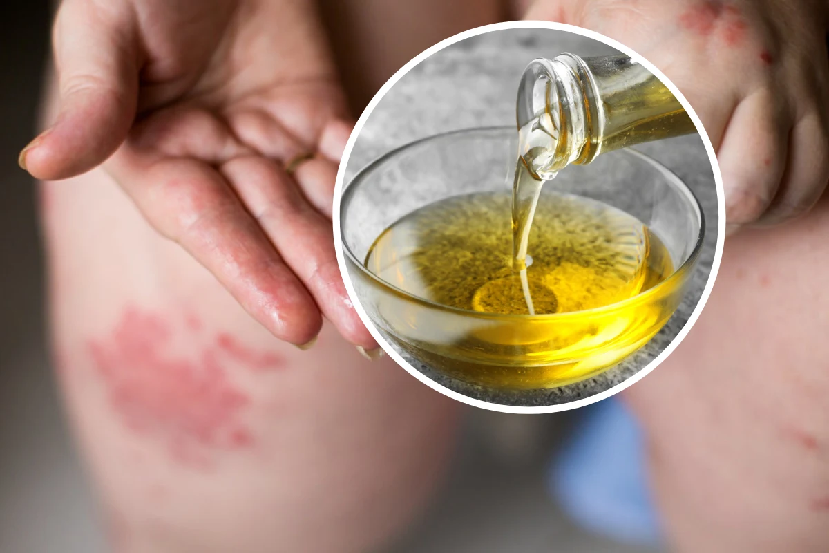 Olej z wiesiołka, olej z lnu oraz oliwa z oliwek podziałają przeciwzapalnie i złagodzą skórne objawy chorób 