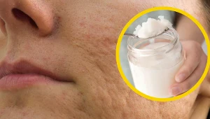 Wśród produktów, które pomagają w walce z bliznami, a które można znaleźć w kuchni, znajduje się m.in. olej kokosowy czy miód