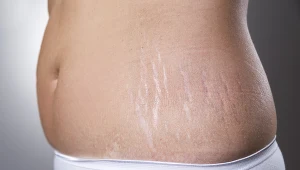  Rozstępy bardzo często pojawiają się po ciąży lub w trakcie stosowania drastycznych diet odchudzających z dużym spadkiem wagi