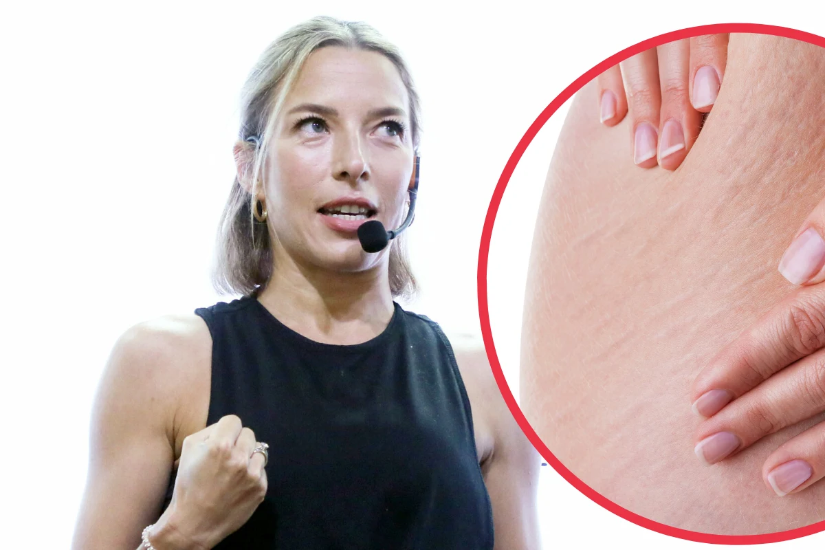 Rozstępy mogą pojawić się bez względu na wagę, wynikają ze słabego nawilżenia skóry, odwodnienia lub niedoborów witaminowych