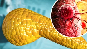 Wykrycie nowotworu trzustki najczęściej odbywa się w jego późnym stadium rozwoju. 