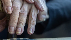 Pionowe bruzdy na paznokciach często występują u osób starszych, ale warto wiedzieć, że mogą świadczyć o chorobach