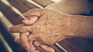 Plamy wątrobowe nie wynikają z problemów z wątrobą, ale są objawem starzenia się skóry