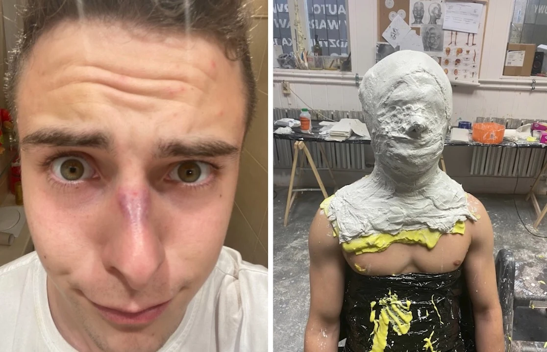 Kuba Zdrójkowski pokazał obrażenia po wykonaniu odlewu twarzy. Kuba Zdrójkowski pokazał obrażenia po wykonaniu odlewu twarzy.