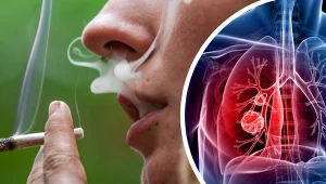 Palenie papierosów zwiększa ryzyko zachorowania na raka płuc kilkunastokrotnie. Bierni palacze również są w grupie ryzyka