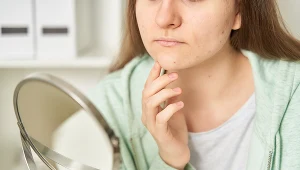 Włoski na brodzie i nad ustami, małe piersi i nadmierne wypadanie włosów mogą świadczyć o problemach hormonalnych