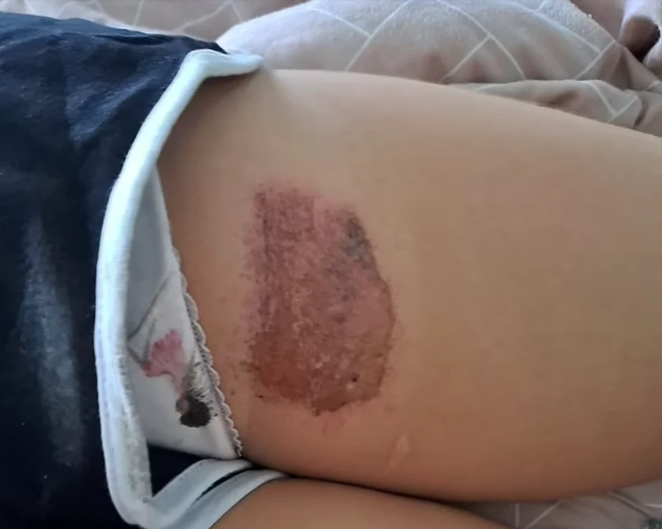 Dziewczynka ma poparzoną nogę. Na szczęście lekarze są dobrej myśli Dziewczynka ma poparzoną nogę. Na szczęście lekarze są dobrej myśli