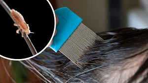 Aby skutecznie pozbyć się wszy, włosy należy starannie wyczesywać grzebieniem o wąsko rozstawionych ząbkach, by pozbyć się gnid