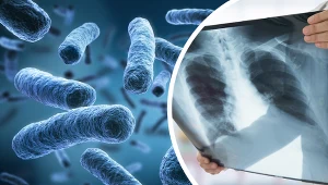 11 przypadków tajemniczego zapalenia płuc, cztery ofiary śmiertelne. Doniesienia z Argentyny wzbudziły niepokój; zdj. ilustracyjne