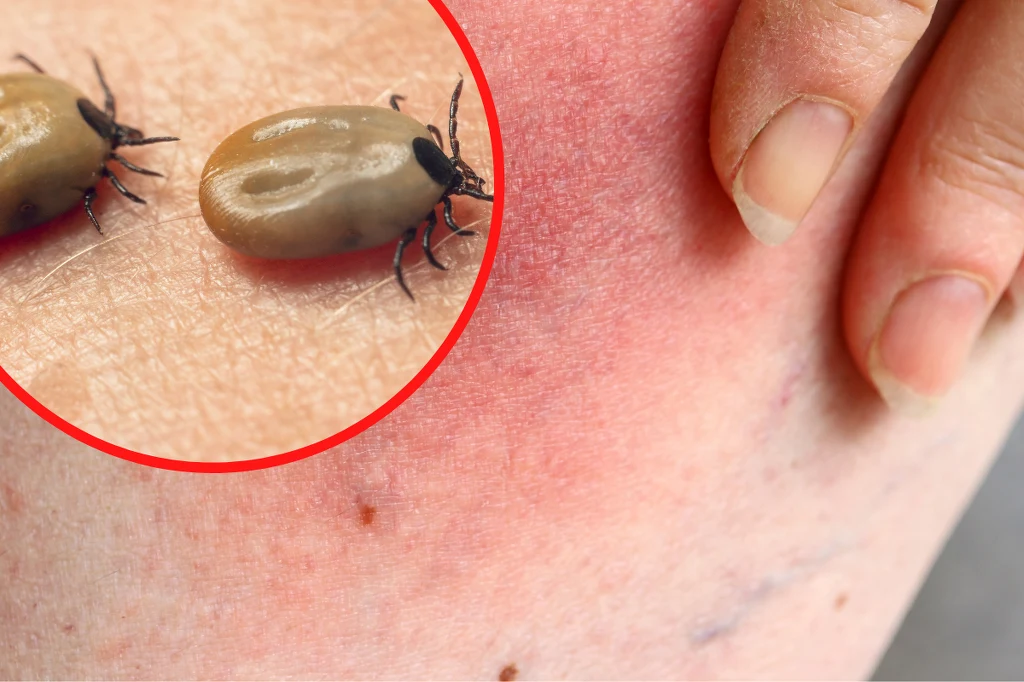 Rumień wędrujący pojawia się we wczesnym stadium boreliozy, ale nie pojawia się we wszystkich przypadkach. Jakie są inne objawy boreliozy?