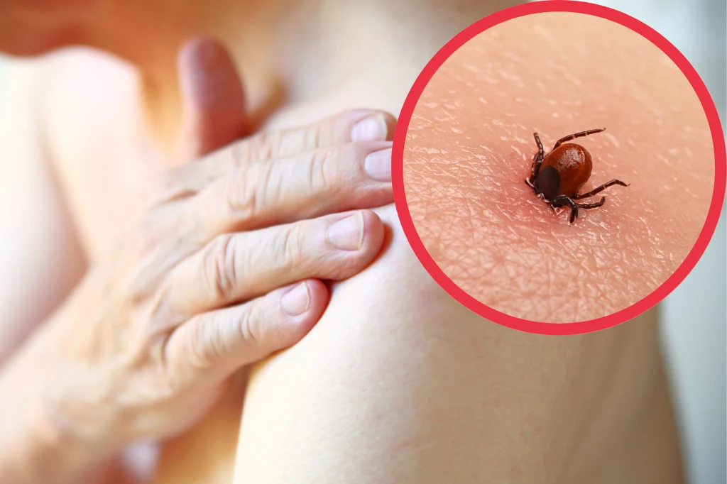 Bóle mięśni, bóle głowy, bóle stawów, uczucie silnego osłabienia - to też są objawy, które mogą wskazywać na boreliozę