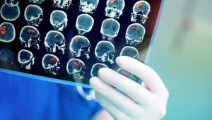 Problem z mową, osłabienie siły mięśniowej i opadnięty kącik ust to pierwsze objawy udaru niedokrwiennego mózgu