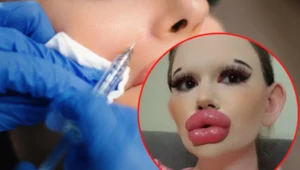 "Bułgarska Barbie" wydała na operacje ust majątek! Wciąż planuje kolejne...