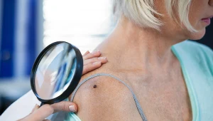 Kontrola skóry po wakacjach to coś, o co powinien zadbać każdy z nas