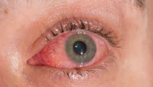 Łzawią ci oczy? To może być choroba. Sprawdź, co oznacza ten objaw