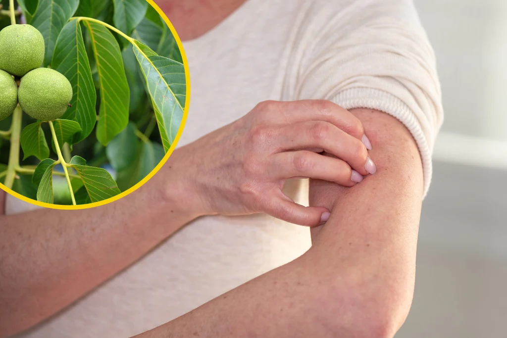 Liście orzecha włoskiego znajdują zastosowanie przede wszystkim w schorzeniach skóry Liście orzecha włoskiego znajdują zastosowanie przede wszystkim w schorzeniach skóry