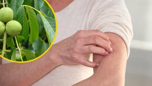 Liście orzecha włoskiego znajdują zastosowanie przede wszystkim w schorzeniach skóry