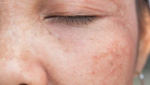 Skóra banknotowa to jeden ze skórnych objawów chorej wątroby. Jest charakterystyczna dla marskości wątroby