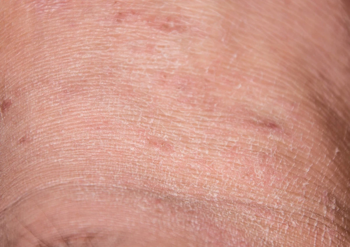 Skóra banknotowa jest cienka, sucha, pomarszczona, jakby postarzała