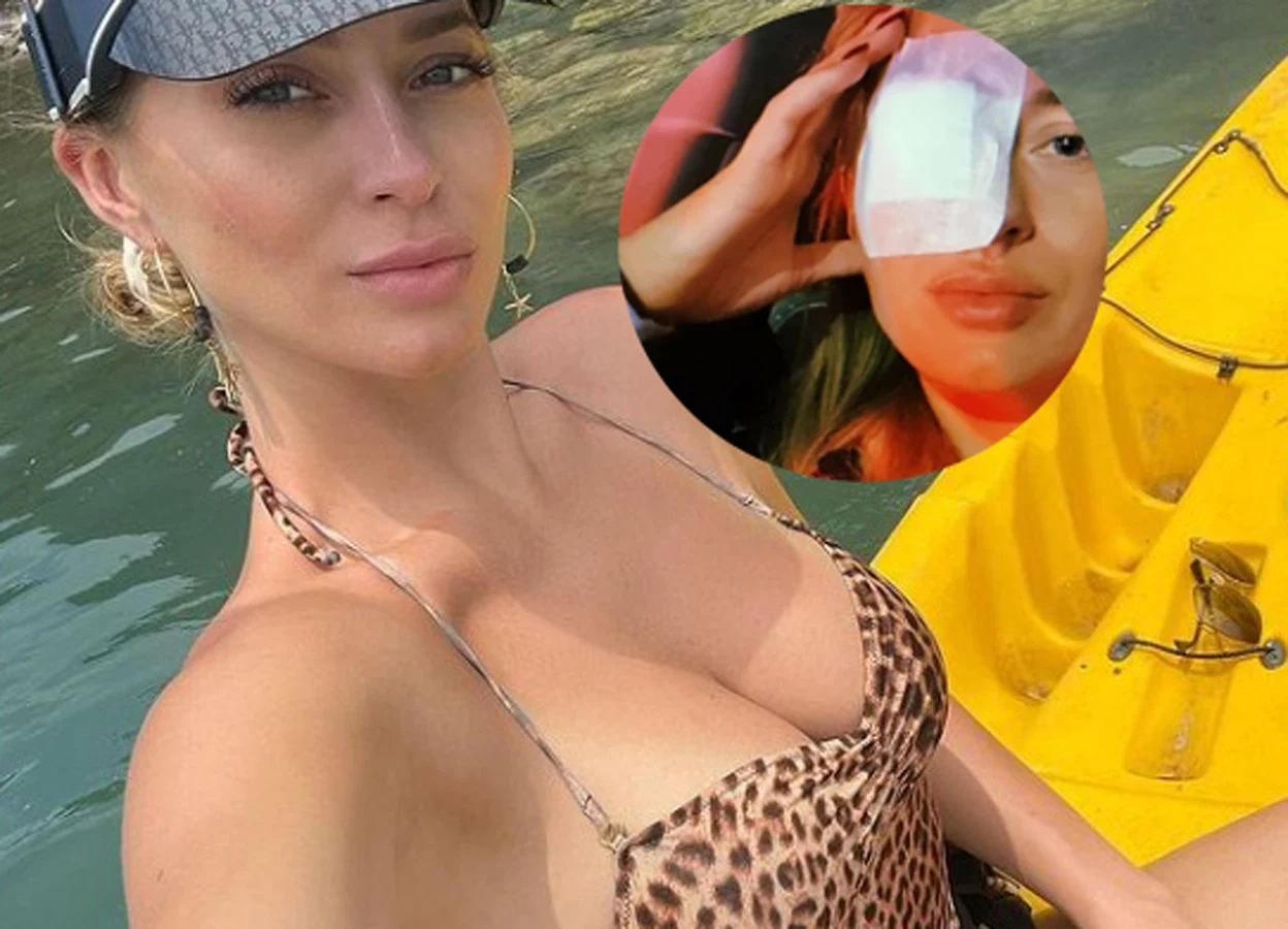 Marcelina Zawadzka musiała wyłyżeczkować powieki Marcelina Zawadzka musiała wyłyżeczkować powieki