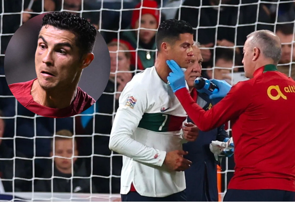 Cristiano Ronaldo przeciwko Hiszpanii zagrałz podbitym okiem Cristiano Ronaldo przeciwko Hiszpanii zagrałz podbitym okiem