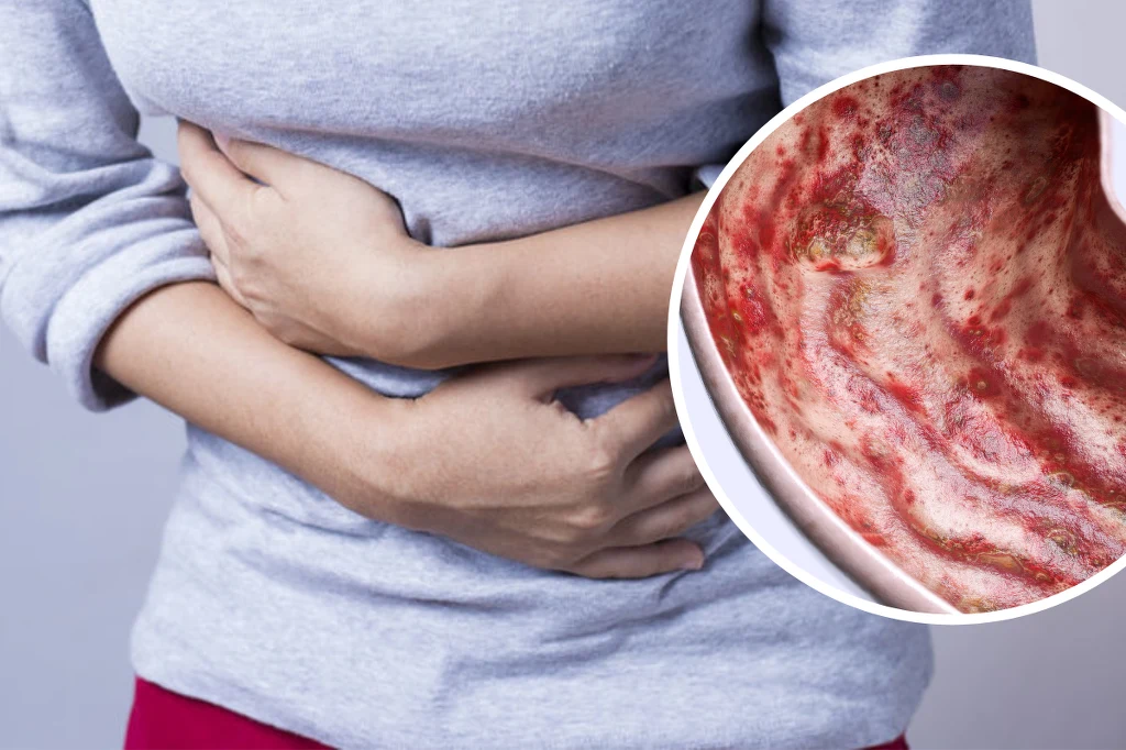 Charakterystyczny objaw godzinę po posiłku? Tak poznasz wrzodziejący narząd Charakterystyczny objaw godzinę po posiłku? Tak poznasz wrzodziejący narząd