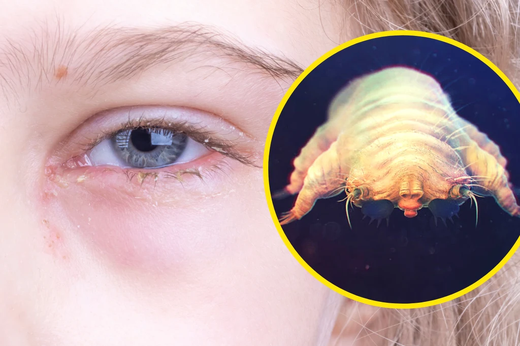 Zakażenie nużeńcem na rzęsach przypomina zapalenie spojówek Zakażenie nużeńcem na rzęsach przypomina zapalenie spojówek