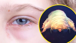 Zakażenie nużeńcem na rzęsach przypomina zapalenie spojówek 