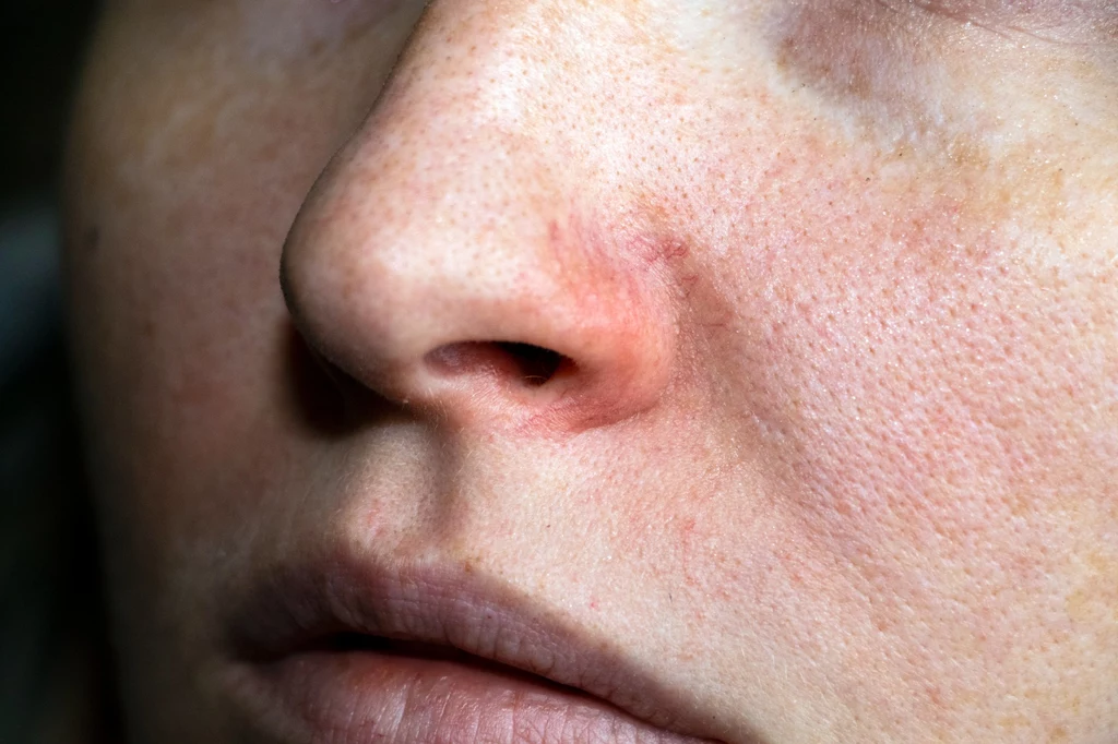 W walce z rozszerzonymi porami istotna jest przede wszystkim odpowiednia pielęgnacja pozwalająca na dokładne oczyszczenie skóry
