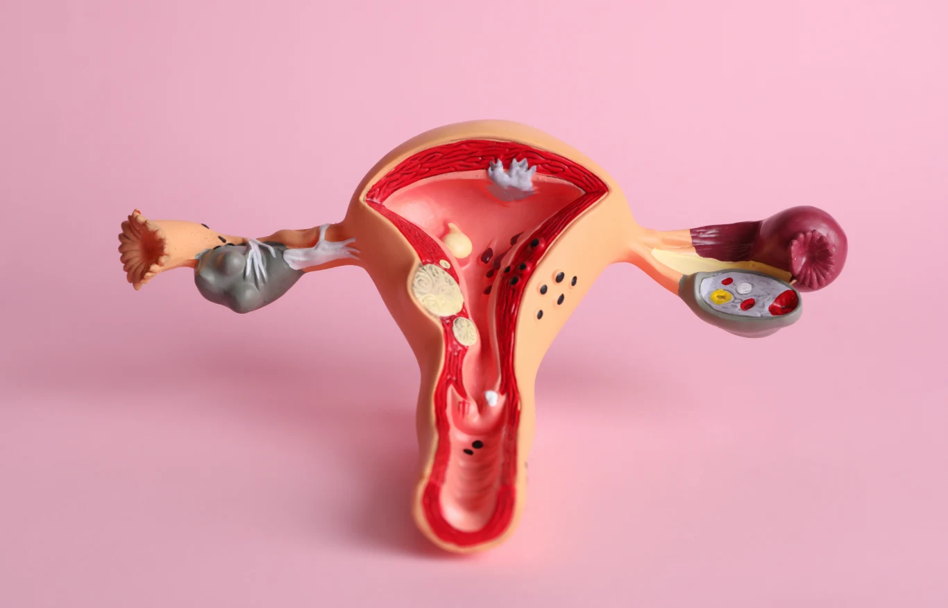 PCOS swoją nazwę zawdzięcza charakterystycznemu obrazowi jajników widocznemu w USG, które są wyraźnie powiększone i pokryte licznymi torbielami. 