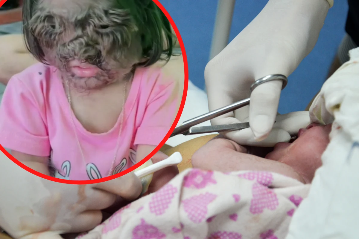 Tzw. syndrom wilkołaka to bardzo rzadkie schorzenie Tzw. syndrom wilkołaka to bardzo rzadkie schorzenie