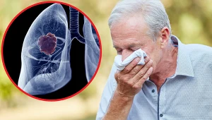 Zmiana charakteru kaszlu palacza może wiązać się z początkiem przewlekłej obturacyjnej choroby płuc (POChP) lub rakiem płuc