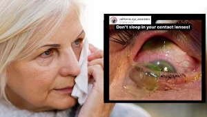 Okulistka w oku jednej ze swoich pacjentek znalazła aż 23 soczewki kontaktowe. Teraz przestrzega innych